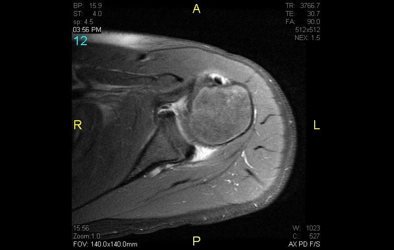 Figure 3 for case anterior shoulder dislocation